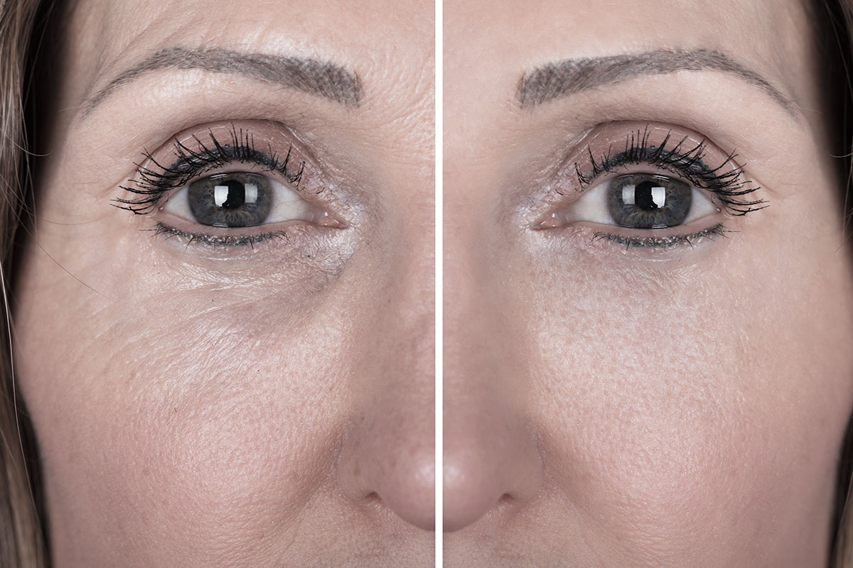 Augenlidstraffung, vor und nach einer OP