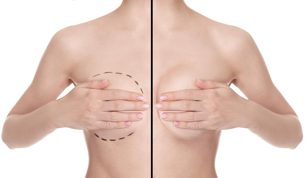 Brustvergroesserung, vor und nach einer OP